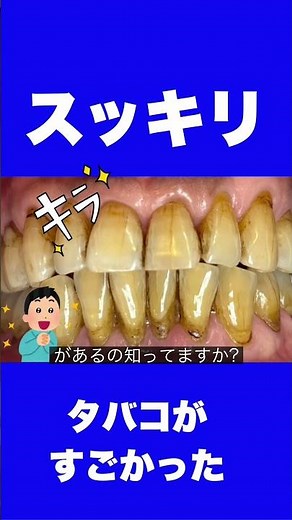 歯周病 歯槽膿漏で歯茎が腫れた 歯肉が痛い 歯が揺れる 口臭の治療 歯石除去 ジェットクリーニング 保険適応 大宮 埼玉県 さいたま市 鈴木歯科医院 歯医者