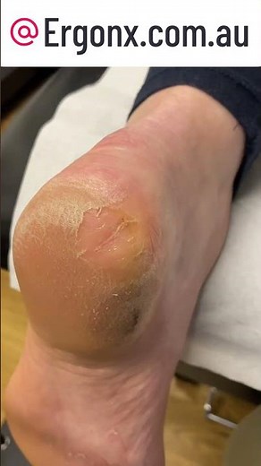 Ultimate Cracked Heel Callus Removal by Expert Podiatrist #Podiatry #FootCare