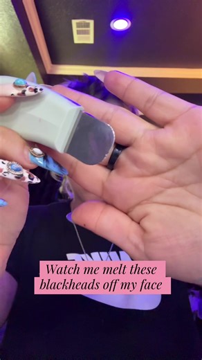 Melt Blackheads Off Your Face Instantly