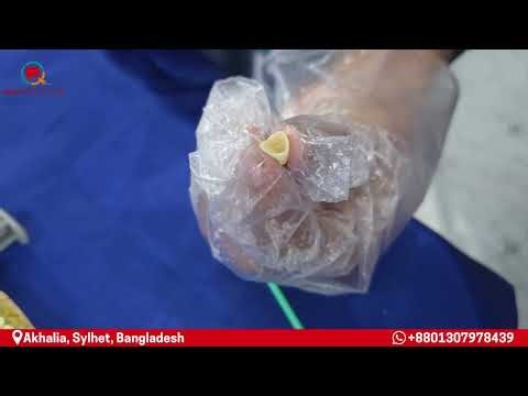 Front Teeth Zirconia Crown makeover – She Looks Stunning! #dentalmakeover #dentist