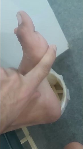 Claw foot | Pes cavus