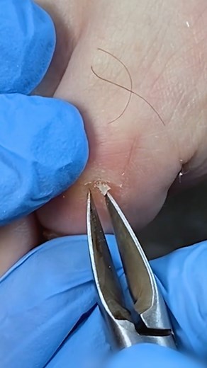 49K views · 131 reactions | Foot corn removal process! | Alena Lavrenteva | Facebook