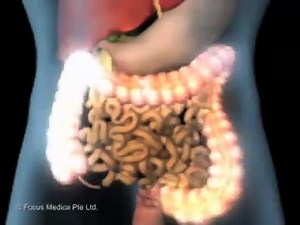 Irritable Bowel Syndrome - IBS (Understanding Disease_ Gastroenterology and Urology)