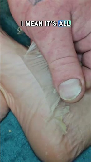 Skin started peeling in 2-3 days after the foot mask! #footmask #footpeel