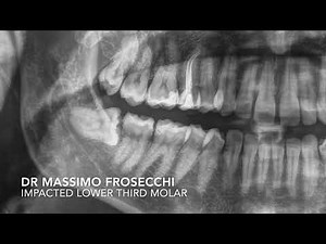 Rapid impacted lower third molar extraction