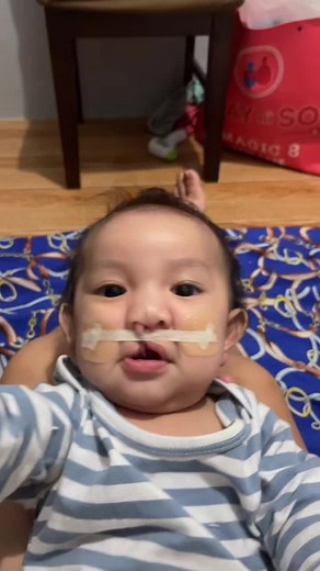 #fyp #cleftlipandpallete #cleftlip #cleftstrong