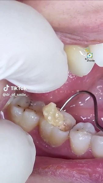 First Molar RCT and Zarcunium Crown Cementation Process