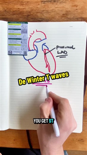 This should be treated as a STEMI If you would like this myocardial infarction card, follow the link in the comments Learn. Adapt. Respond. #ecg #heartattack #paramediclife #nursetiktok #medicalstudent