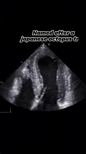 Takotsubo cardiomyopathy on Echocardiography
