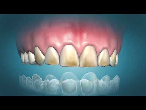 Venus White PRO teeth whitening