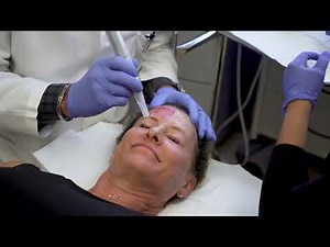 Microneedling and PRP, Procedure Breakdown