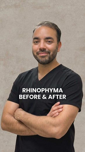 BEFORE & AFTER: Rhinoplasty, this patient had Rhinophyma. Rhinophyma is a skin condition causing the nose to become large, red, bumpy, and bulbous, often from advanced rosacea, involving thickened skin, enlarged oil glands, and prominent pores. While linked to rosacea and sometimes mistaken for alcohol use, it’s a complex immune issue, more common in older fair-skinned men, and treated surgically with options like lasers or electrosurgery to reshape the nose. rhinoplasty, nose job, nose, rhino,