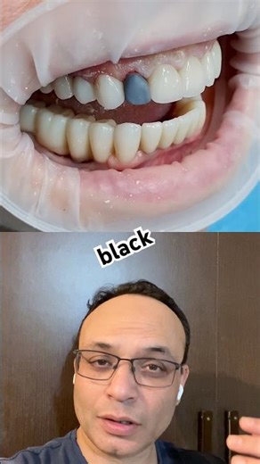 Black Tooth for a Smile? 😳