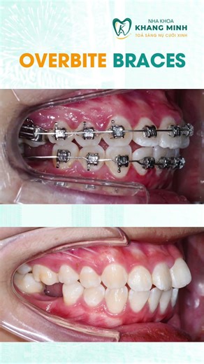 Overbite braces #shorts #orthodontist #dentistry #braces