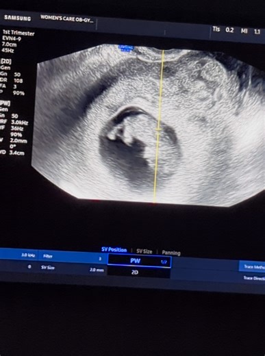 From Empty Sac to Baby: A Journey Through Subchorionic Hematoma