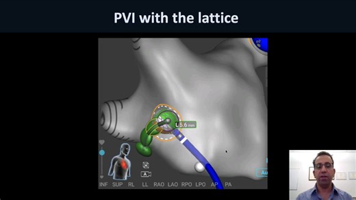 结合RFA(射频消融)和PFA(脉冲电场