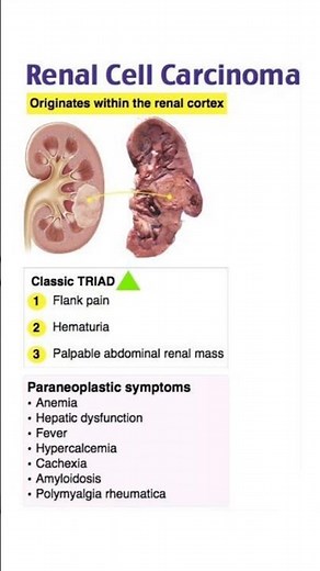 What is Renal Cell Carcinoma? #mbbs #bams #bhms #study #nursing #nclex #medical #shorts
