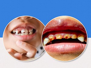 What Causes Tooth Decay In Kids? Know Causes And Prevention Tips from Doctor
