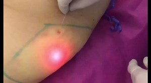 Láser-M La Laserlipolisis NO genera el traumatismo de la liposucción...