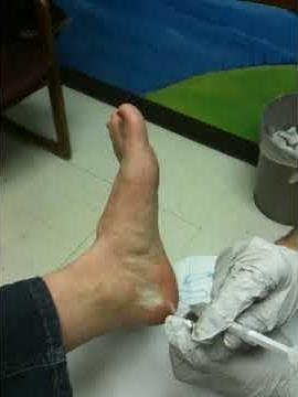 Placing a Cortisone Injection into the Plantar Fascia