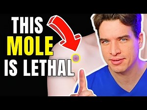 CANCER WARNING! If Your MOLE Looks Like THIS, It Could Be DEADLY