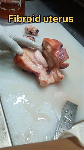 Fibroid uterus specimen 🤔| #histopathology #histomuseum #cervicaltreatment #cervicalpolyp #uterus