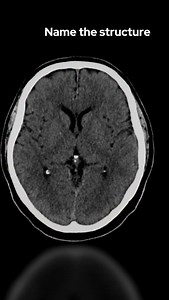 32K views · 1.5K reactions | CT HEAD ANATOMY Axial slice of a non...