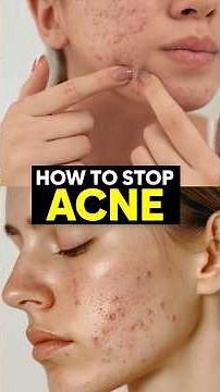 Benzoyl Peroxide Gel for Acne 🔥 Clear Pimples Fast | Before After Results #Shorts