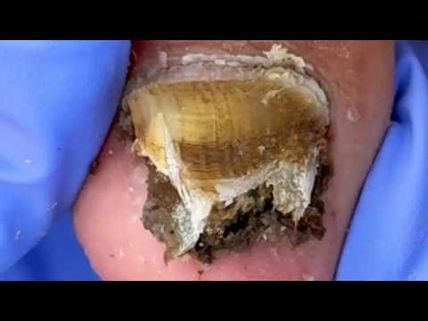Black Toenails, Clean And Trim Them In Time【Dr Liu's Pedicur】