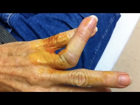 Finger is dislocated out of joint