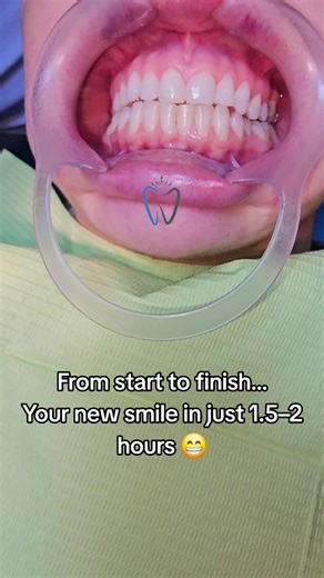 Achieve Your Perfect Smile with Composite Bonding