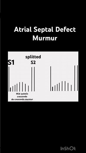Murmur of Atrial Septal Defect,Wide and fixed splitting of S2 due to delayed Pulmonary valve closure