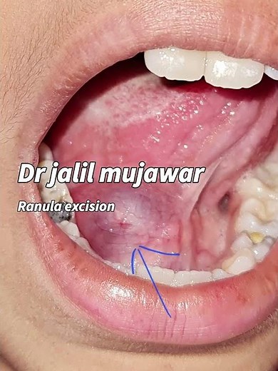 ranula . sublingual mucous cyst .excision. dr jalil mujawar