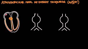 Atrioventricular reentrant tachycardia (AVRT) & AV nodal reentrant tachycardia (AVNRT)