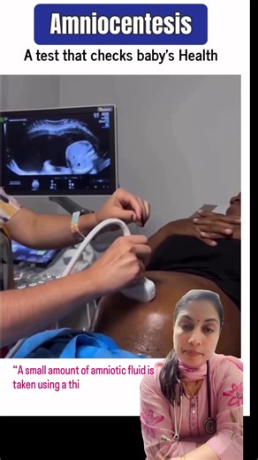 Amniocentesis procedure under ultrasound guidance for prenatal genetic diagnosis.