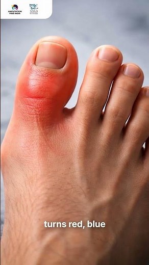 Your Toes Turning Black? 😨 This Could Lead to Amputation | Don’t Ignore This Warning!