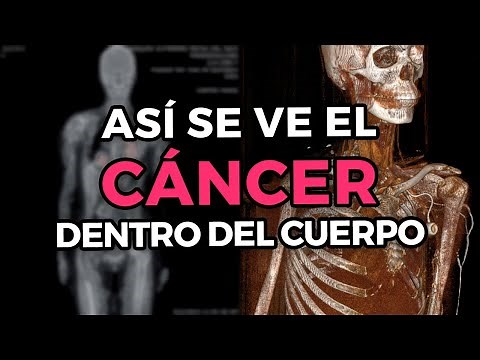 The best way to see Cancer in pictures- PET CT Scanner