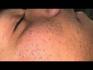 Mia's Korean Skincare Routine (For Pimple-Free Glowing Skin)