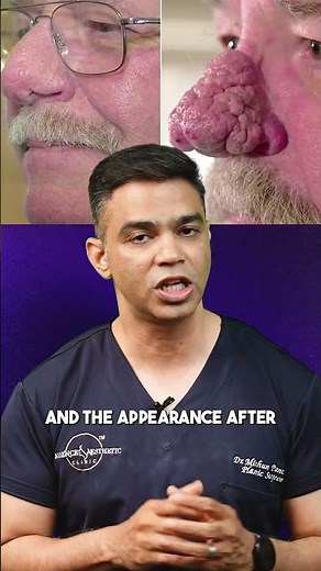 This condition is known as Rhinophyma.