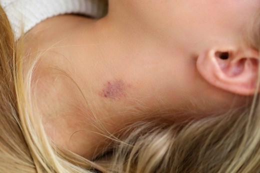 Dealing with a hickey? 8 home remedies to help get rid of it fast