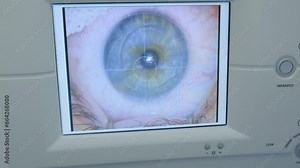An imaging system showing a clear image of the cornea during surgery. View of the monitor, femtosecond laser operation.