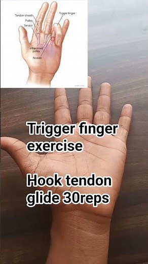 Easy and effective exercise, trigger finger , reduce pain and stiffness #correctiveexercise