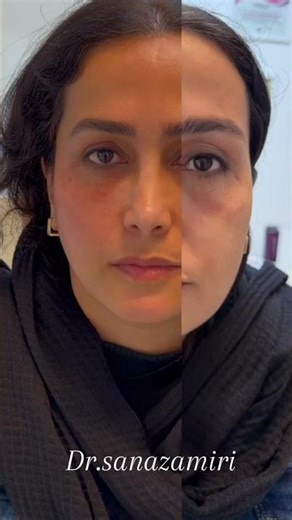 Under-Eye Rejuvenation Using Alternative Cheek Codes | One-Session Result