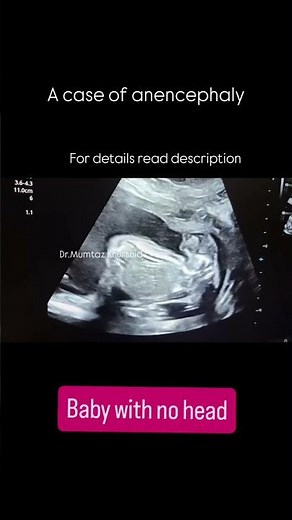 Anomaly Scan showing Abnormal Baby with no Head