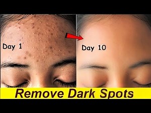 How to Remove Dark Spots from Face Naturally at Home ✨
