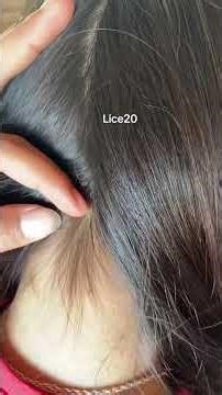 (Part 201) Removing Lice by Hand Satisfying Lice #lice #liceremoval #shortsfeed #shorts #shortsviral