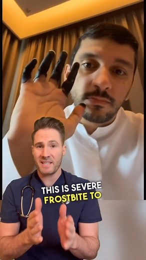 Dr. Joe, M.D. on Instagram: "There are different degrees or stages of frostbite, each with its own symptoms and treatment. First-degree frostbite affects only the outer layer of skin, causing redness, swelling, and a tingling or burning sensation. Second-degree frostbite affects deeper layers of skin and causes blisters, swelling, and a pale or blueish color. Third-degree frostbite affects even deeper tissues, including muscles and tendons, and causes blackened, dead tissue and severe swelling.