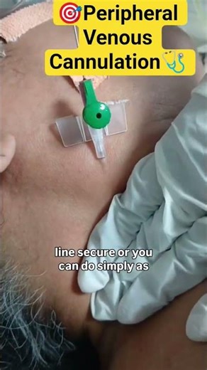 🎯💉 Peripheral Venous Cannulation #icudoctor #savealife #shortvideo @Life_in_ICU_yt👈 Subscribe 🩺