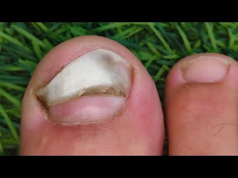 Nail Recovery Process | Before & After