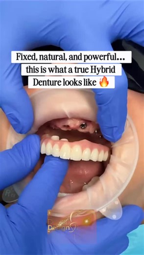 Dental Design Smile on Instagram: "✨ Hybrid Denture: A New Era for Your Smile ✨ At Dental Design Smile, we transform smiles with our Hybrid Denture, a fixed, comfortable, and ultra-natural solution designed to restore confidence, function, and beauty in one procedure. 🦷 💎 With advanced technology, high-quality materials, and a fully customized design, we create a smile that is strong, harmonious, and ready to shine in every moment of your life. 🌟 More stability 🌟 More confidence 🌟 More natu